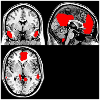 Abnormal Default Mode Network Homogeneity in Treatment-Naive Patients With First-Episode Depression